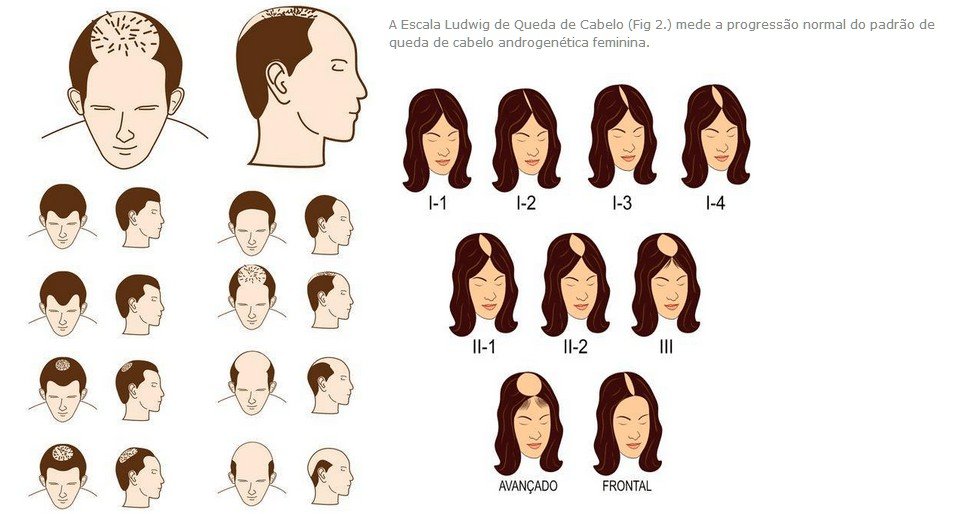 Alopécia Androgenética